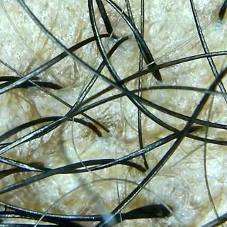 San Diego Hairloss Specialist, Melinda Galloway, has over 20 years experience helping clients with h