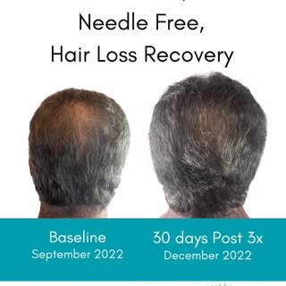 We’ve got the power to help clients experiencing hair loss! TED is changing hair loss in a groundbre