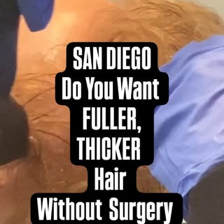 SAN DIEGO! Are you ready for fuller, thicker hair without surgery? Alma TED Hair Restoration Treatme