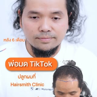สิ่งที่คนดูไม่เคยสังเกต...อยู่บนหัวเขา #hair #hairtransplant #ปลูกผม #ผมบาง  #รีวิวปลูกผม