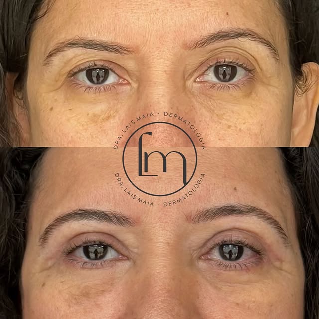 Olhar pesado, cansado e com aspecto envelhecido não é apenas uma questão estética. Muitas vezes impa