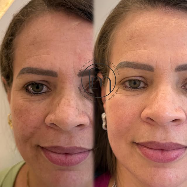 3 meses. ⏳

Esse foi o tempo necessário para transformar uma pele marcada pelo melasma em uma pele m