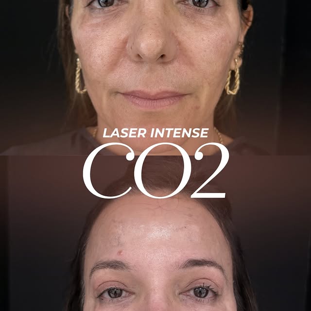 Um resultado que fala por si só! ✨

O Laser Intense CO₂ chegou na clínica!!! 

É possível promover u