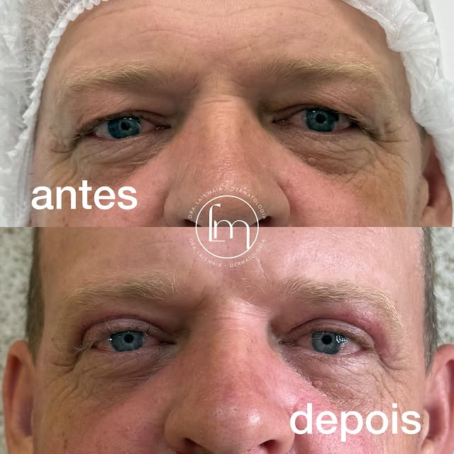 O excesso de pele nas pálpebras fazia com que o olhar parecesse mais cansado e escondia uma das cara