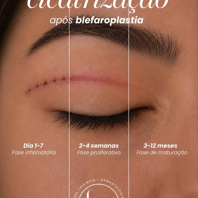 A cicatriz da blefaroplastia passa por diferentes fases de cicatrização, e cada uma delas é esperada