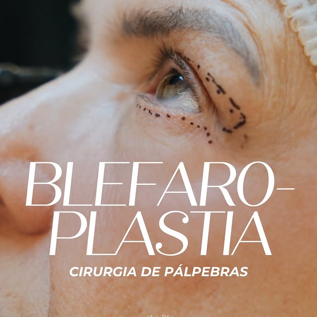 Às vezes, a blefaroplastia vai muito além da estética.

Ela pode devolver um olhar mais descansado, 