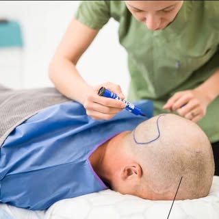 Hair transplant is only possible if a patient has sufficient amount of hair in the donor area at the