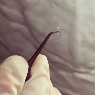 A triple hair graft that is ready to be implanted into patient's crown area. Grafts that have multip