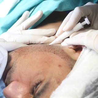 We also offer beard hair transplant operations at our clinic. We can create a full beard or only fil