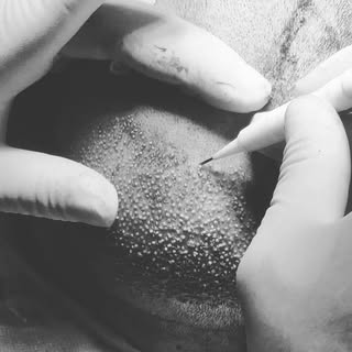 👉Did you know that we also offer hair restoration using the Choi Implanter Pen‼️

#dhi 
#hairtransp