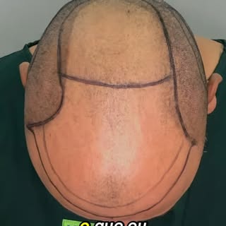 Resultado do Transplante Capilar para Entradas 7 meses de evolução

As entradas marcadas incomodavam