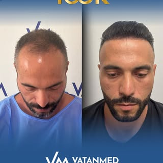 VatanMed Clinic’te saç ekimi planı tamamen kişiye özel hazırlanır.
Doğal saç çizgisi ve yoğun sonuçl