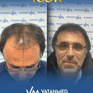 GERÇEK SONUÇLAR, GERÇEK DEĞİŞİM

Saç ekimi sonrası doğal ve yoğun görünüm.
Kişiye özel planlama ile 