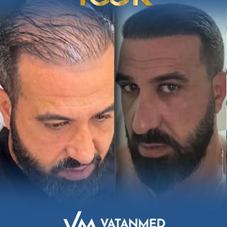 VatanMed Clinic’te saç ekimi planı tamamen kişiye özel hazırlanır.
Doğal saç çizgisi ve yoğun sonuçl