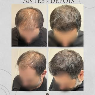 Um resultado natural que entrega mais confiança, autoestima e jovialidade. E ao mesmo tempo mantendo