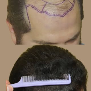 AVA FUE vs Traditional FUE 

The AVA FUE technique (Automatic Vacuum-Assisted FUE) has gained global