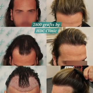 At HDC Hair Clinic, the focus is clear:

✦ Dense, refined results, without overharvesting
✦ Hairline