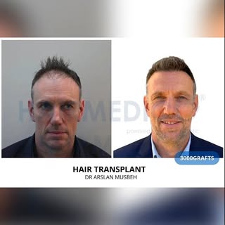 Dr. Arslan at Hairmedico Clinic in Turkey is known for delivering natural and dense hair transplant 