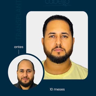 10 meses depois do transplante capilar.

Com o objetivo de alta densidade e naturalidade. É assim qu