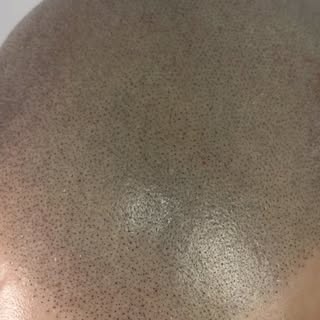 Dis Adieu à la calvitie 👋🏽

📍 Algiers 
📱 +213 784 278 981

#smp #micropigmentation #scalpmicropi
