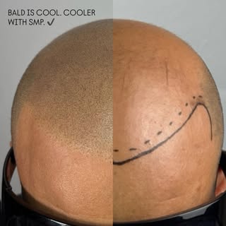 Change your life. Regain your confidence. 😏

#smp #scalpmicropigmentation