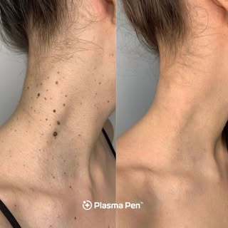 “Precision removal, refined results! 💥✨ Just leveled up my skin at @EliteCutis! #GlowUp”