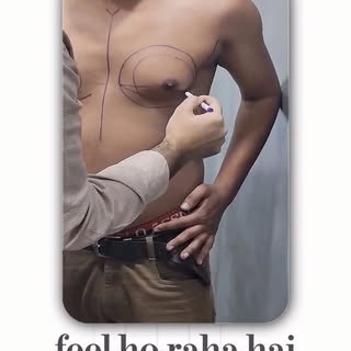 Myth: All male chest fullness is just stubborn fat.
Reality: It could be True Gynecomastia, which is