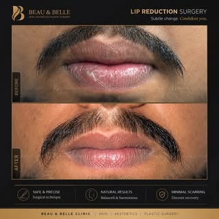 ✨ Natural Balance. Refined Confidence.

Every face is unique, and so is every smile.

This patient u