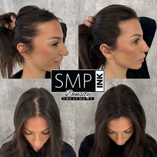 Filling in natural looking density can be done permanently and instantly! No hair fibers, no filling