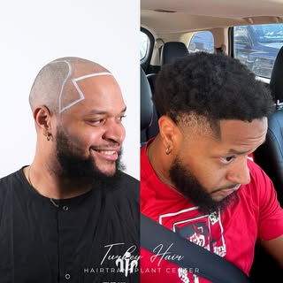“The Most Natural Afro Hairline – From the USA to Istanbul”

🎥 From the heart of the USA to the han