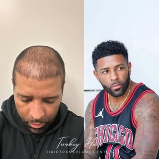 “A Smooth Journey to Hair Restoration – Quick, Painless, and Effective!” 
🎥 They searched the world