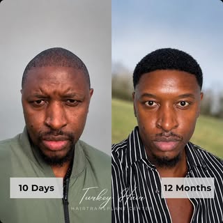 Afro Hair Before & After — The Result Speaks for Itself.

10 days vs 12 months.

One of the most imp