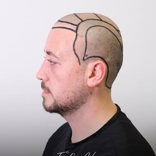 A clear plan is the first step toward a natural result.
Every hair transplant journey starts with de