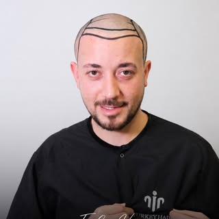 A new hairline, a new confidence. 👍
Every great transformation starts with a personalized plan.

Wo