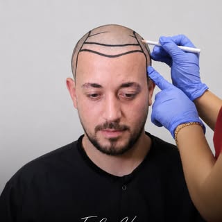Every successful hair transplant starts with a precise hairline plan. ✨
A natural look is not just a