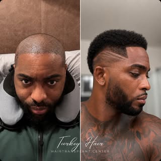 🔥 Afro Hair Transplant Result

A natural hairline. Strong density. Real confidence.

Every Afro hai