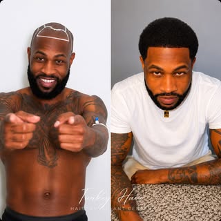 🔥 Afro Hair Transplant Result

A new hairline can change everything.

This patient wanted a stronge
