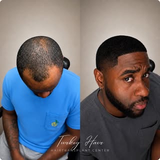 🔥 Afro Hair Transplant Real Result

From a receding hairline to a stronger, fuller, and more define