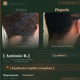 Alopecia Parmaviculata, já ouviu falar? 
Assista até o final! 
#alopecia #quedadecabelo