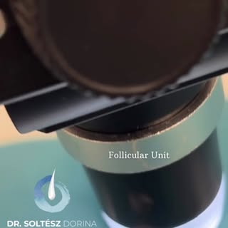 🤩 Follikuláris egységek (graftok) szakállból 🤩 
Donor területnek lehet használni a szakállat:
✅ sz