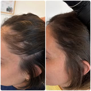 Avant / Après – Tricopigmentation femme

Cette cliente souffrait d’une alopécie de traction, liée à 