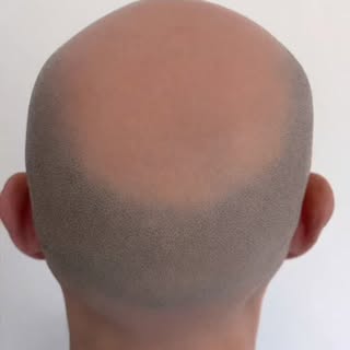 “Voici un avant / après d’un vertex en effet crâne rasé.

Sur l’avant, on observe une perte marquée 