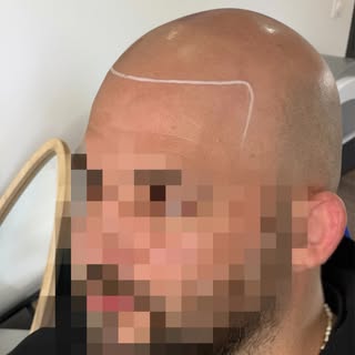 🚨 La tricopigmentation n’est pas qu’une question de points. 🚨

Le plus important est de créer une 
