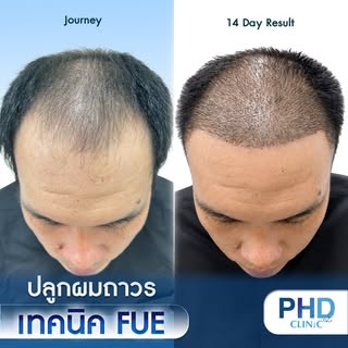 หลายคนถามเข้ามาว่า หลังทำ FUE แล้วใช้เวลานานไหมกว่าจะดูดีขึ้น? วันนี้ PhD Clinic อยากให้คุณเห็นผลลัพ