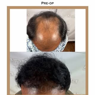 This patient came to Dr. Arocha with advanced thinning and was seeking a natural, fuller appearance 