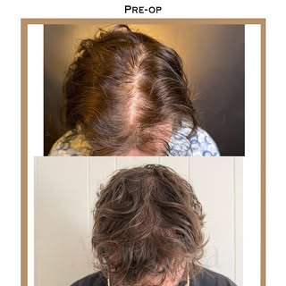 Two years post-op and the results speak for themselves. This patient underwent a 2500 graft FUE proc