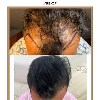 Three years later after a hair transplant with Dr. Arocha and the results speak for themselves.

Thi