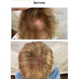 This patient is 6 months out from her single PRP session. Swipe to see the natural transformation! 
