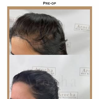 Hair loss doesn’t just affect men. It can affect women 50% by the time they reach the age of 50. Thi