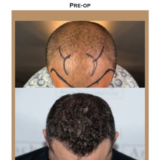 This patient came to Dr. Arocha several years ago to address the thinning he was experiencing in his